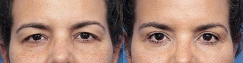 Eyelid Surgery (Blepharoplasty) Before & After Gallery - Patient 58490472 - Image 1