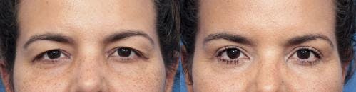 Eyelid Surgery (Upper Blepharoplasty) Before & After Gallery - Patient 58490472 - Image 1