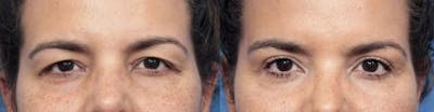 Eyelid Surgery (Upper Blepharoplasty) Before & After Gallery - Patient 58490472 - Image 1