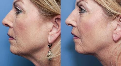 Neck Lift Before & After Gallery - Patient 58490473 - Image 1