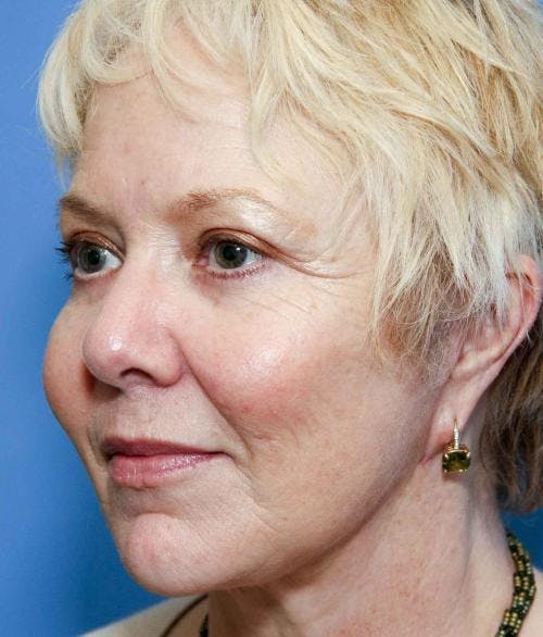 Face Lift Before & After Gallery - Patient 58490475 - Image 4