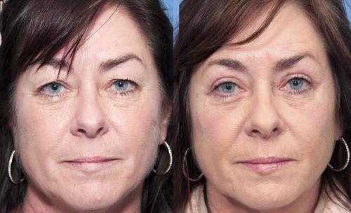 Eyelid Surgery (Upper Blepharoplasty) Before & After Gallery - Patient 58490474 - Image 1