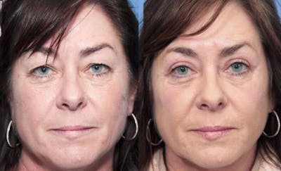 Eyelid Surgery (Upper Blepharoplasty) Before & After Gallery - Patient 58490474 - Image 1