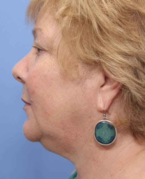 Face Lift Before & After Gallery - Patient 58490475 - Image 5