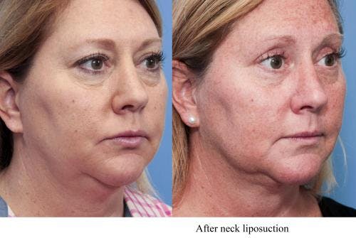 Neck Lift Before & After Gallery - Patient 58490476 - Image 2