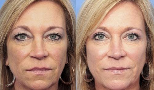 Eyelid Surgery (Upper Blepharoplasty) Before & After Gallery - Patient 58490477 - Image 1