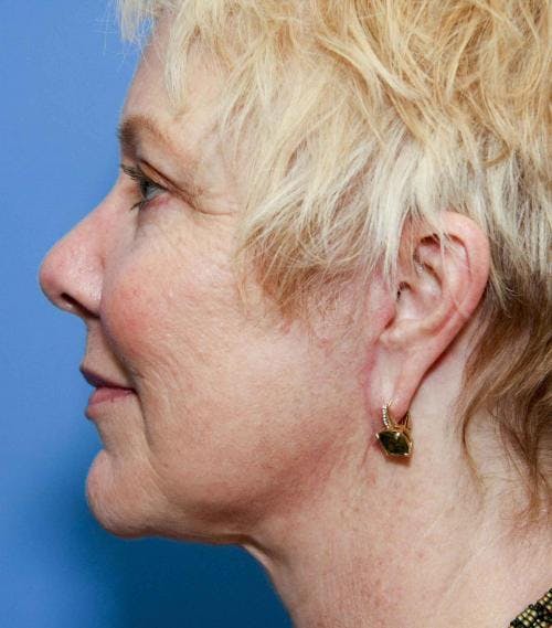 Face Lift Before & After Gallery - Patient 58490475 - Image 6