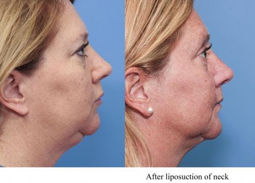 Neck Lift Before & After Gallery - Patient 58490476 - Image 1