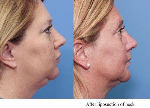 Neck Lift Before & After Gallery - Patient 58490476 - Image 1
