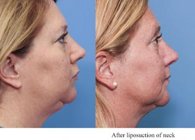 Neck Lift Before & After Gallery - Patient 58490476 - Image 1