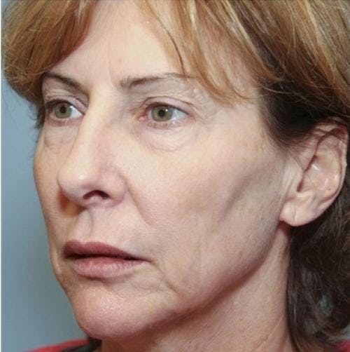 Face Lift Before & After Gallery - Patient 58490486 - Image 3