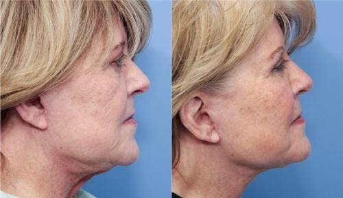 Neck Lift Before & After Gallery - Patient 58490481 - Image 3