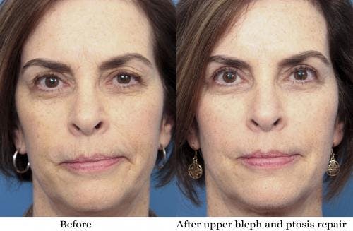 Eyelid Surgery (Upper Blepharoplasty) Before & After Gallery - Patient 58490478 - Image 1