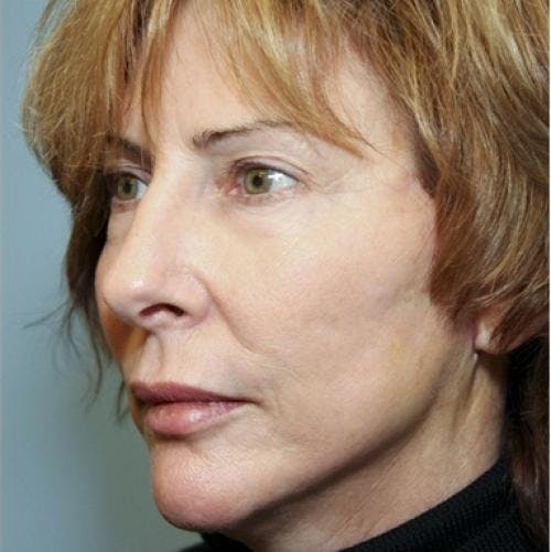 Face Lift Before & After Gallery - Patient 58490486 - Image 4