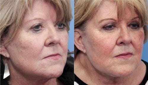 Neck Lift Before & After Gallery - Patient 58490481 - Image 2