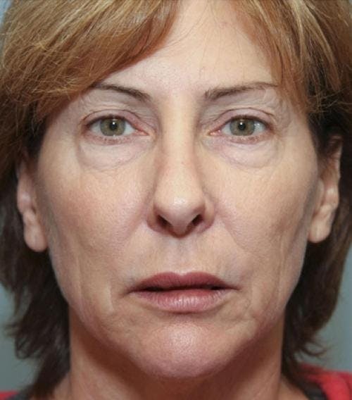 Face Lift Before & After Gallery - Patient 58490486 - Image 1
