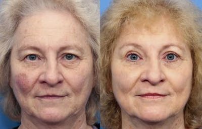 Eyelid Surgery (Upper Blepharoplasty) Before & After Gallery - Patient 58490480 - Image 1