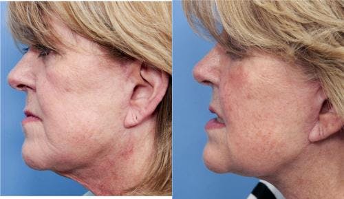 Neck Lift Before & After Gallery - Patient 58490481 - Image 3