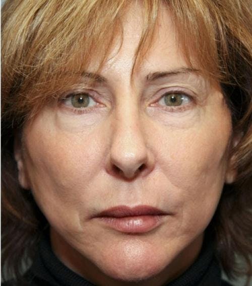 Face Lift Before & After Gallery - Patient 58490486 - Image 2