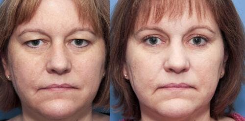 Eyelid Surgery (Blepharoplasty) Before & After Gallery - Patient 58490482 - Image 1