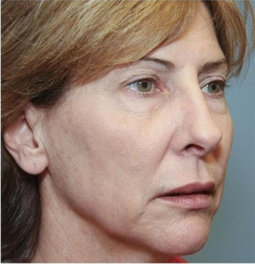 Face Lift Before & After Gallery - Patient 58490486 - Image 5