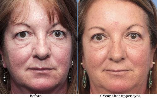 Eyelid Surgery (Upper Blepharoplasty) Before & After Gallery - Patient 58490485 - Image 1