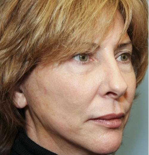 Face Lift Before & After Gallery - Patient 58490486 - Image 6