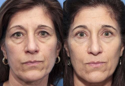 Eyelid Surgery (Upper Blepharoplasty) Before & After Gallery - Patient 58490488 - Image 1