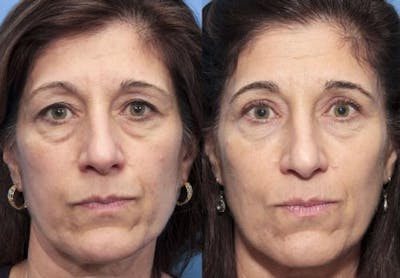 Eyelid Surgery (Upper Blepharoplasty) Before & After Gallery - Patient 58490488 - Image 1