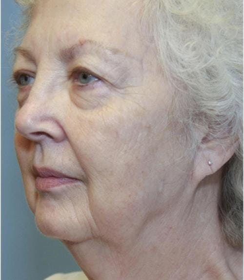 Face Lift Before & After Gallery - Patient 58490492 - Image 3