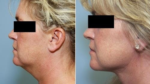 Neck Lift Before & After Gallery - Patient 58490490 - Image 1