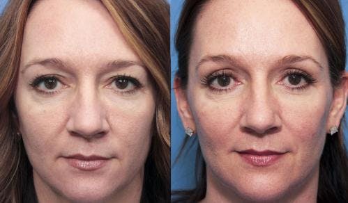 Eyelid Surgery (Blepharoplasty) Before & After Gallery - Patient 58490489 - Image 1