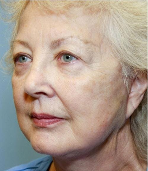 Face Lift Before & After Gallery - Patient 58490492 - Image 2