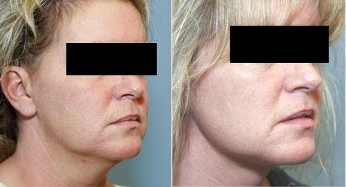 Neck Lift Before & After Gallery - Patient 58490490 - Image 2