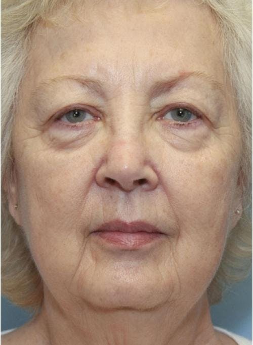 Face Lift Before & After Gallery - Patient 58490492 - Image 1