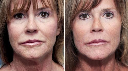 Eyelid Surgery (Upper & Lower Blepharoplasty) Before & After Gallery - Patient 322495 - Image 1