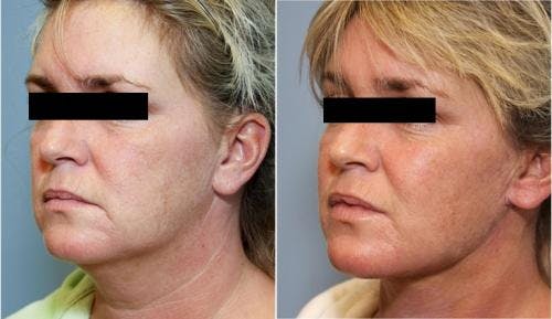 Neck Lift Before & After Gallery - Patient 58490490 - Image 3