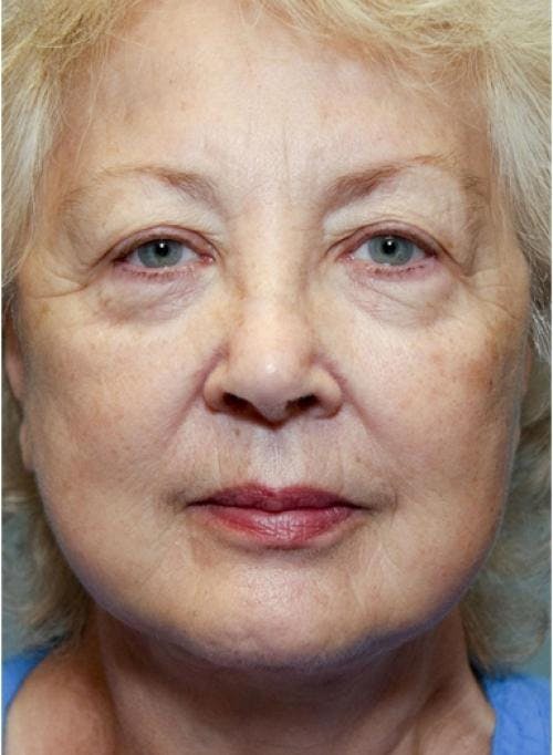 Face Lift Before & After Gallery - Patient 58490492 - Image 2