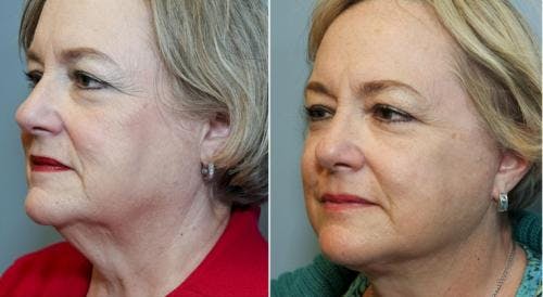 Neck Lift Before & After Gallery - Patient 58490493 - Image 2