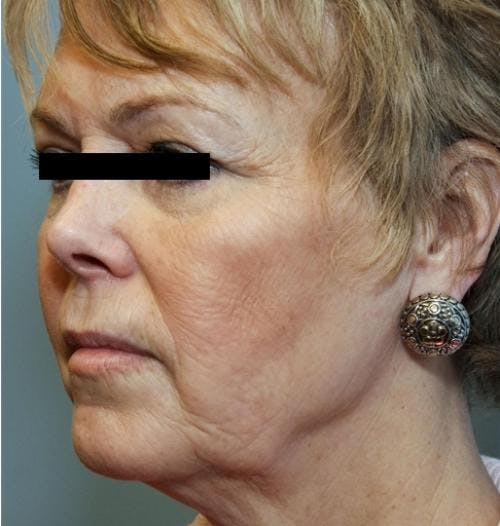 Face Lift Before & After Gallery - Patient 58490495 - Image 1
