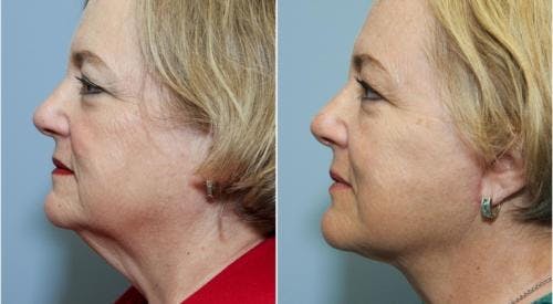 Neck Lift Before & After Gallery - Patient 58490493 - Image 1