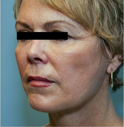 Face Lift Before & After Gallery - Patient 58490495 - Image 2