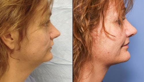 Neck Lift Before & After Gallery - Patient 58490494 - Image 1