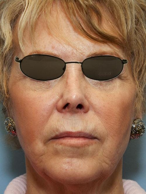 Face Lift Before & After Gallery - Patient 58490495 - Image 3