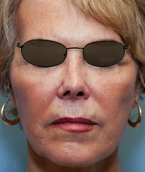 Face Lift Before & After Gallery - Patient 58490495 - Image 4