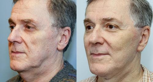 Neck Lift Before & After Gallery - Patient 58490496 - Image 1