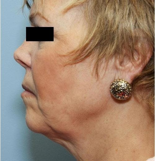 Face Lift Before & After Gallery - Patient 58490495 - Image 5