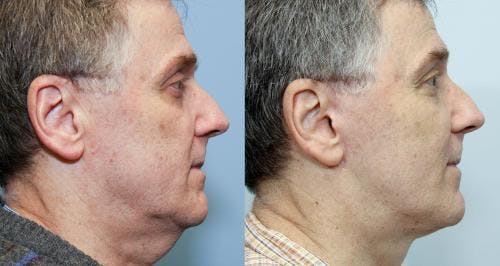 Neck Lift Before & After Gallery - Patient 58490496 - Image 2