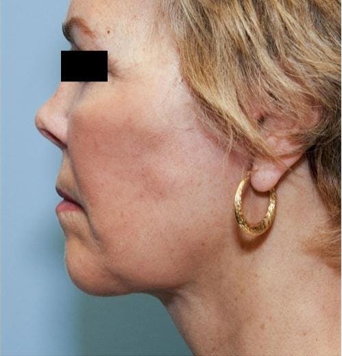 Face Lift Before & After Gallery - Patient 58490495 - Image 6