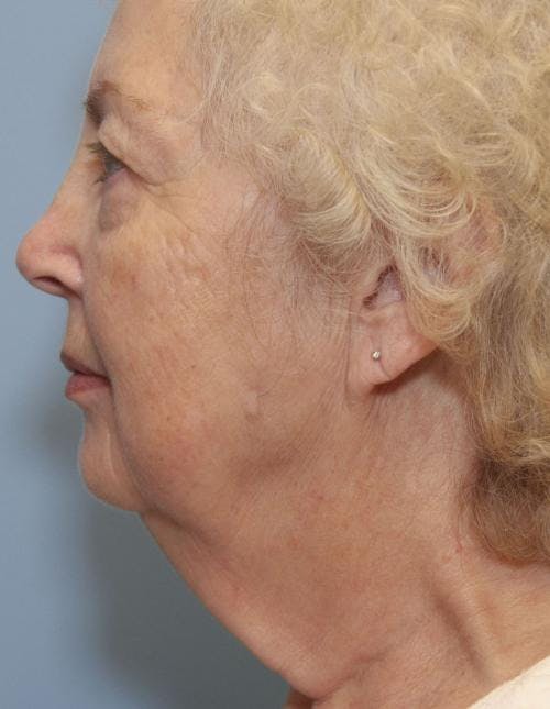 Neck Lift Before & After Gallery - Patient 58490499 - Image 1